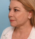 Face Lift/ Neck Lift
