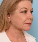 Face Lift/ Neck Lift