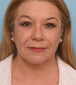 Face Lift/ Neck Lift