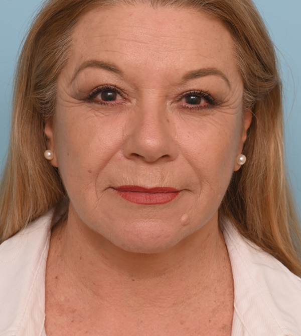 Face Lift/ Neck Lift