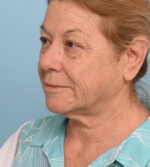 Face Lift/ Neck Lift