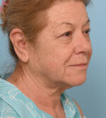 Face Lift/ Neck Lift
