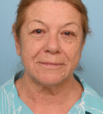 Face Lift/ Neck Lift