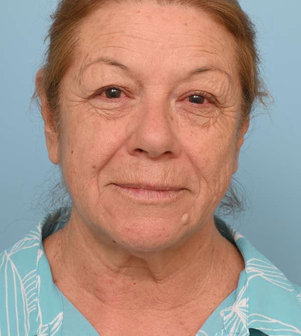 Face Lift/ Neck Lift