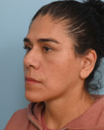 Facial Fat Transfer