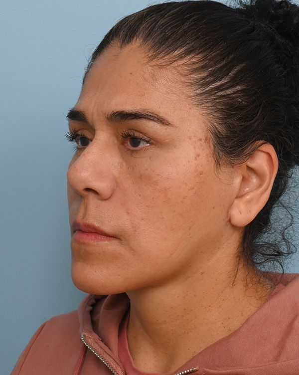 Facial Fat Transfer