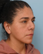 Facial Fat Transfer