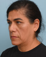 Facial Fat Transfer
