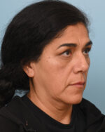Facial Fat Transfer