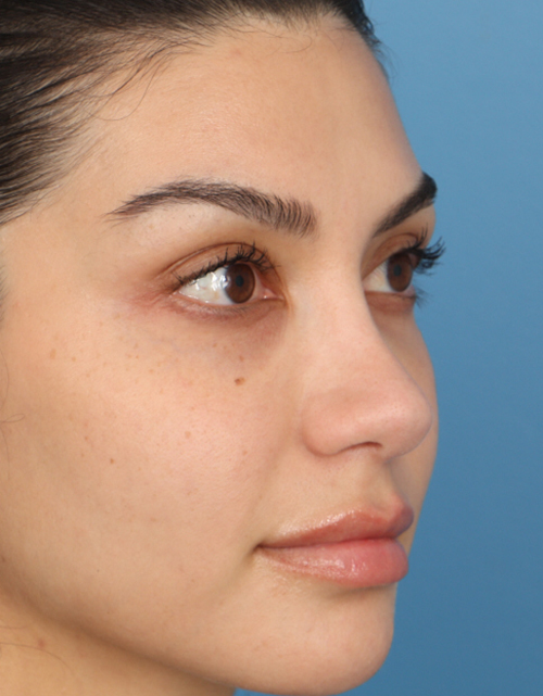 Rhinoplasty