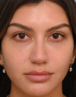 Rhinoplasty