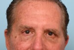 Eye Rejuvenation