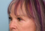 Eye Rejuvenation