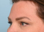 Brow Lift