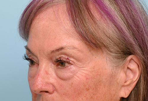 Eye Rejuvenation