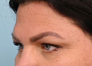 Brow Lift