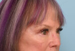 Eye Rejuvenation