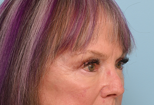 Eye Rejuvenation