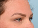 Brow Lift