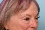 Eye Rejuvenation