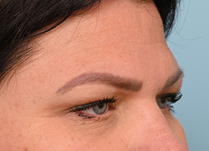 Brow Lift