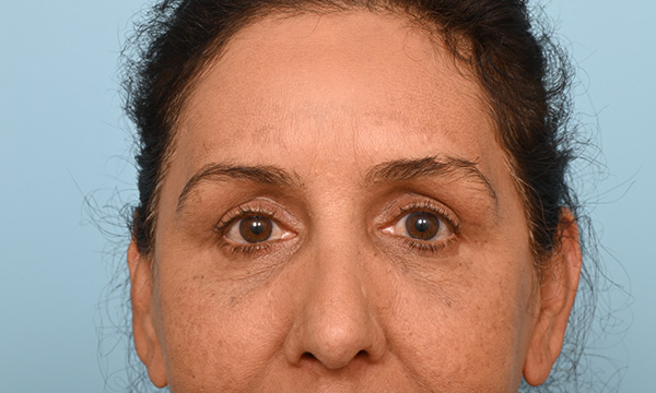 Eye Rejuvenation