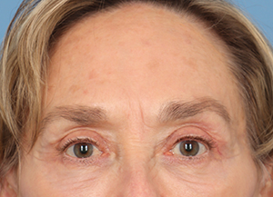 Brow Lift