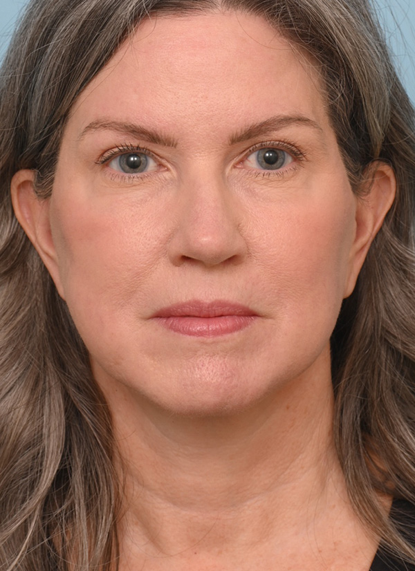 Face Lift/ Neck Lift