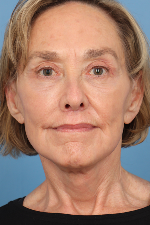Face Lift/ Neck Lift