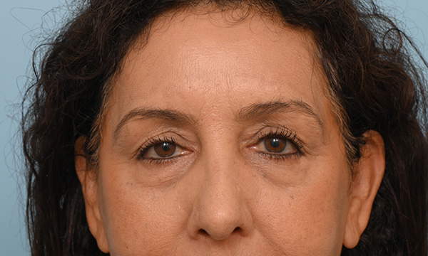 Facial Fat Transfer