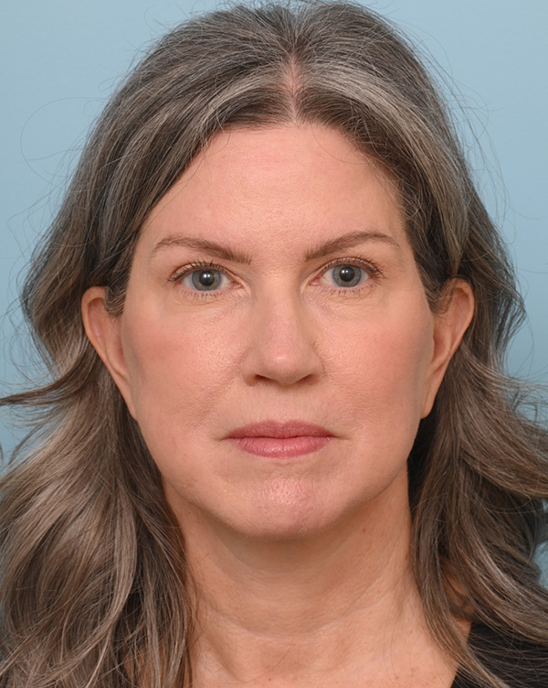 Facial Fat Transfer