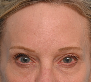 Brow Lift