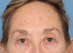 Brow Lift