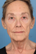 Face Lift/ Neck Lift