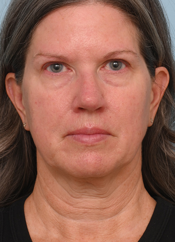Face Lift/ Neck Lift