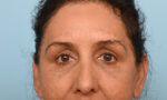 Facial Fat Transfer