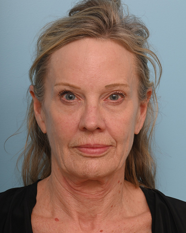 Facial Fat Transfer