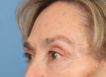 Brow Lift