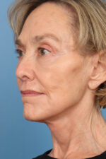 Face Lift/ Neck Lift