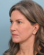 Facial Fat Transfer