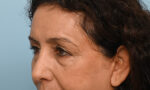 Facial Fat Transfer