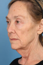 Face Lift/ Neck Lift