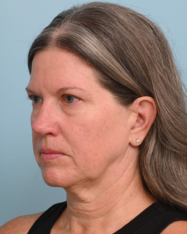 Facial Fat Transfer
