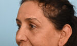 Facial Fat Transfer