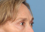 Brow Lift