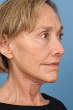Face Lift/ Neck Lift