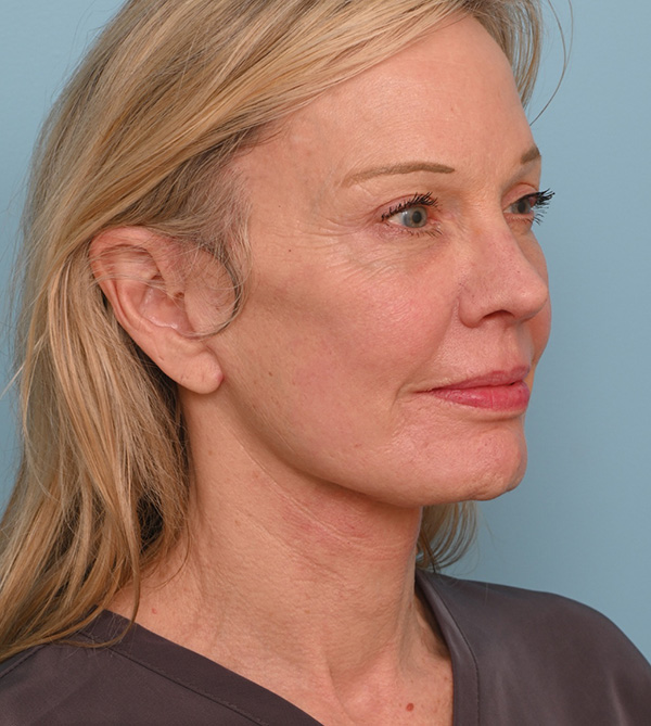 Face Lift/ Neck Lift