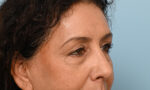 Facial Fat Transfer