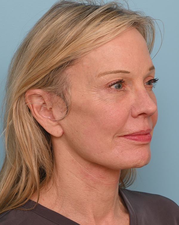 Facial Fat Transfer