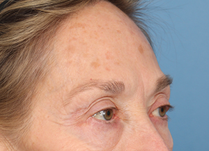 Brow Lift